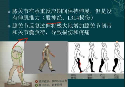 上半身前倾代偿股四头肌无力的步态,从而导致膝关节过伸.