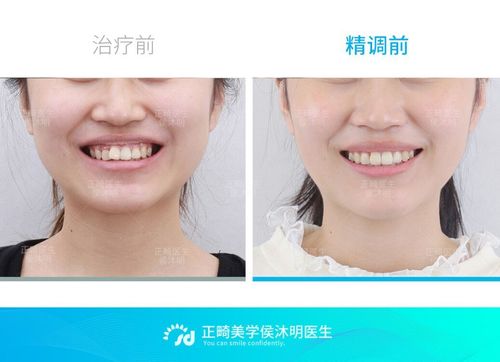 隐适美矫正牙齿拥挤伴牙弓狭窄案例