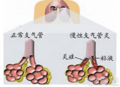 小儿毛细支气管炎如何护理