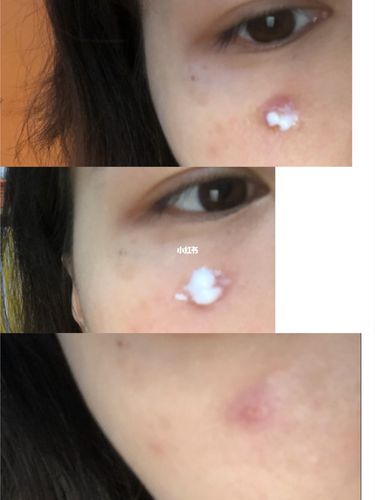 去疤_痘痘_火疖子_医疗健康_医疗