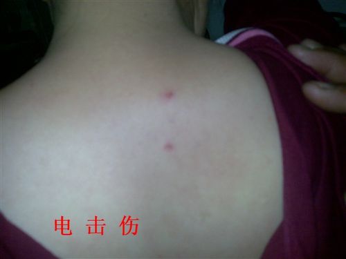 被电棍击伤