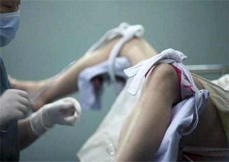 无痛人流手术过程