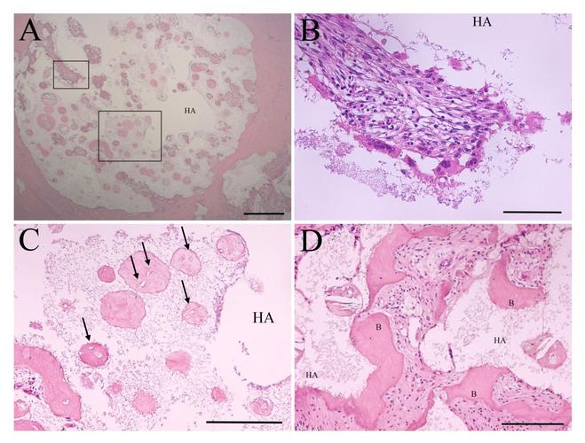 postoperative lumbar spinal stenosis after intertransverse