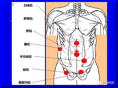腰疝的诊断及手术治疗