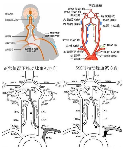 图3 锁骨下动脉窃血导致脑缺血的血流动力学原理