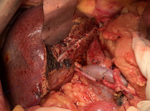 "肝门部胆管癌"回顾