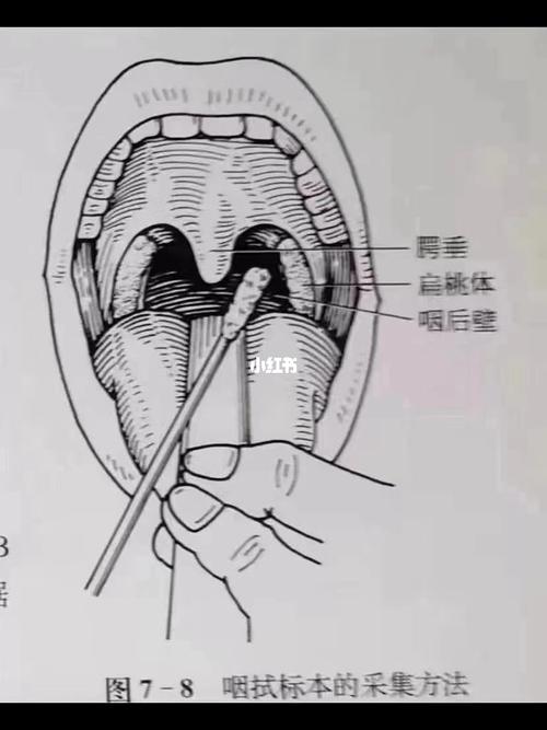 简单小知识:咽拭子采集位置是在两侧腭弓和咽,扁桃体.