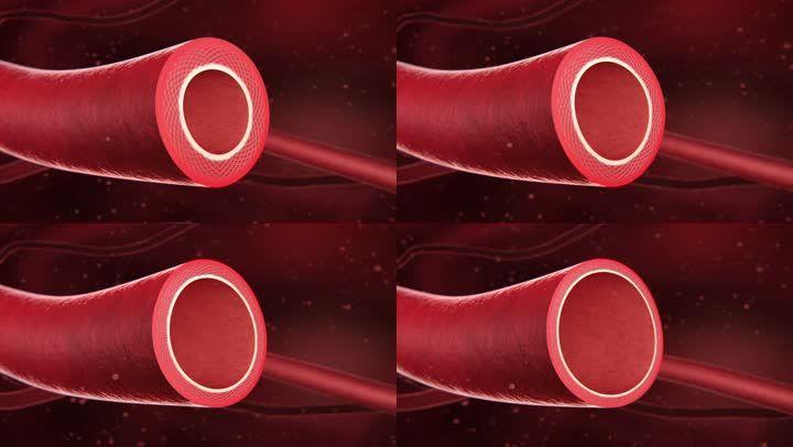 血管壁扩张无老化