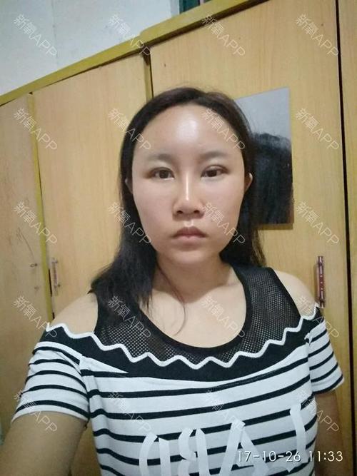 眼综合上眼睑提肌手术失败了吗