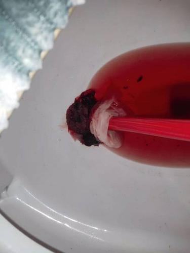 药流排出来的是这一坨肉吗