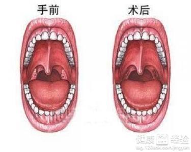 咽白喉的症状图片是怎么样的