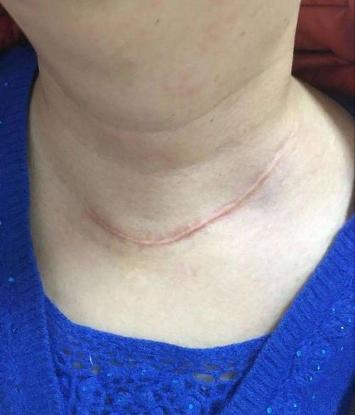 留住您的美丽——我院仙葫院区普通外科成功开展甲状腺腔镜手术