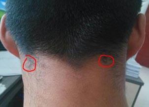 问:脖子后面对称长了俩疙瘩,有两年时间了,不疼不痒.