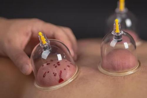 不正确拔罐反要命!