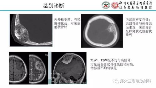颅骨嗜酸性肉芽肿的病例分析