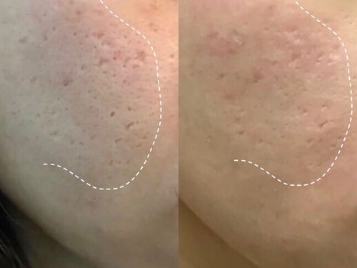 【点阵激光——治疗痘坑】放了对比图,术前和术后13天,面部的痂皮已经