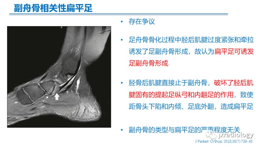 足副舟骨分型及相关病变