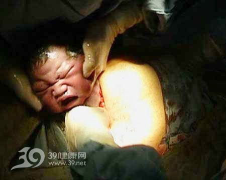 血腥惊恐 剖腹产现场实拍