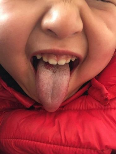 女儿3岁了从小舌头上就长了个小红疙瘩,请专业人士给解答一下是什么