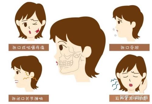 张大嘴巴口腔咔咔响,可能是颞下颌关节紊乱症