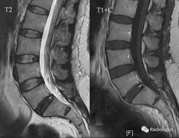 纤维环裂隙(annular fissures)