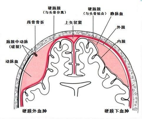 这一睡差点就是一世——谈急性硬膜外血肿-健康频道-手机搜狐白小军