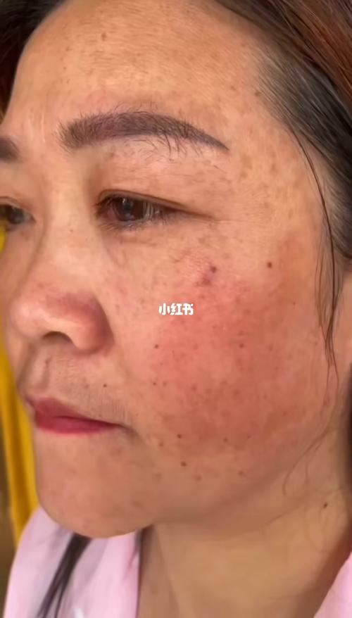 加盟商亲自打版 操作前先留影95 特别严重的雀斑77黄褐斑77真皮