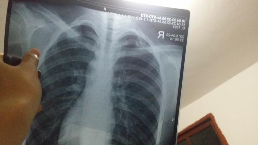 医院拍了几张胸片,肺部有什么症状吗
