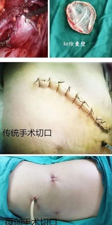 山东菏泽市二院利用微创手术成功完成腹腔镜下肾囊肿