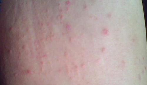 衣服也可引起过敏,大致有3种情况:一是对棉,毛,皮,丝,麻,化纤等织物