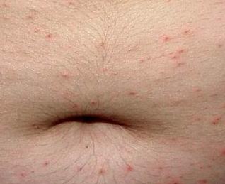 疥疮的病因是什么