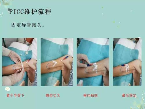 【ppt】picc导管的维护