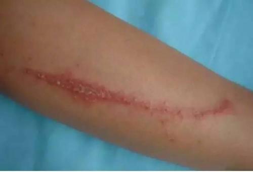 隐翅虫来了!拍死它,你皮肤会在15秒溃烂,真要注意!