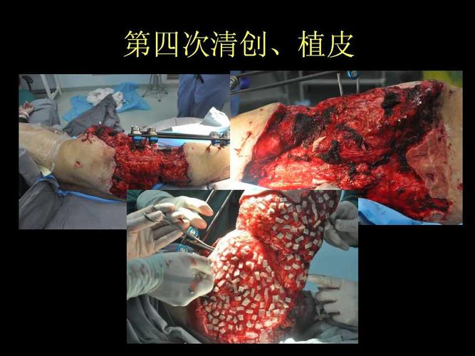 开放性骨盆骨折处理要点