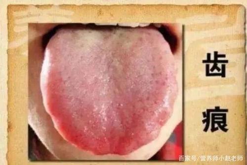 一,舌头肥大 舌头胖大有"齿痕",说明体内湿气重.
