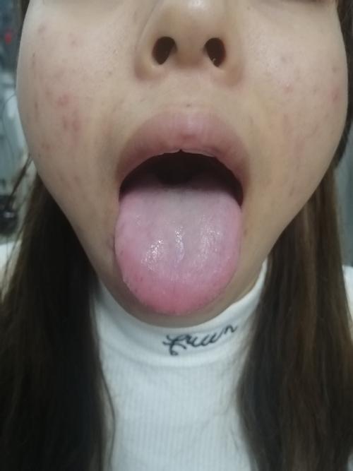 淡白舌薄白苔,舌边有小红点