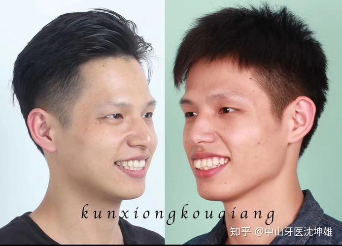 骨性龅牙,下巴后缩的拔牙矫正