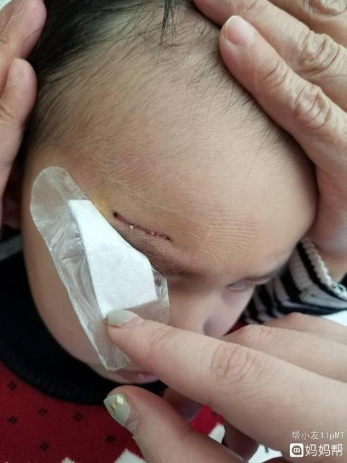 宝宝撞伤 组织胶水粘后会留疤吗