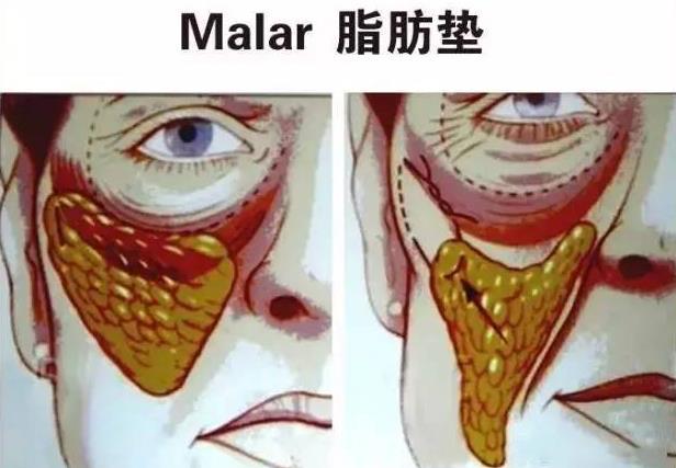 抗衰医生宋超超 提升面部脂肪垫和smas筋膜层的优势