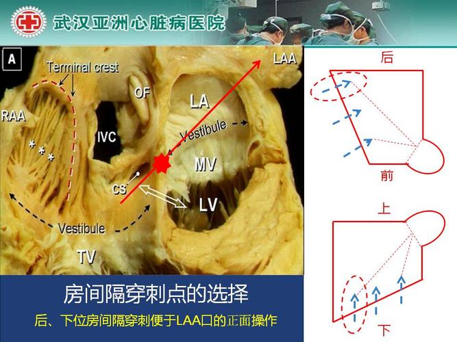 左心耳封堵治疗 适应症与手术策略