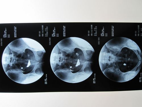 碘油造影是以碘化油为造影剂所进行的经x线的子宫输卵管造影.