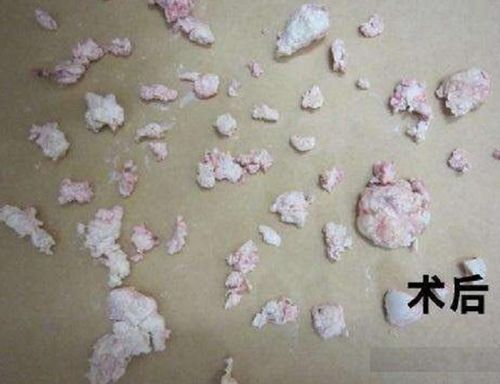 大叔到医院检查后,医生经过详细检查,给他做了微创手术,然后将痛风石