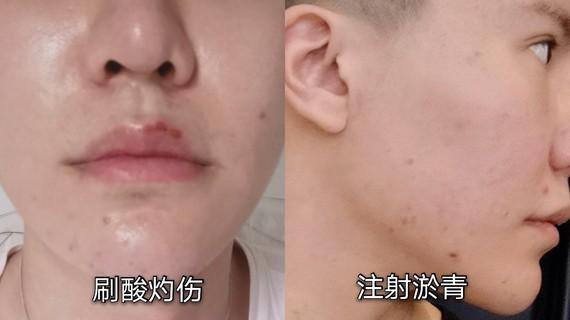 美容院或者自己家用导致的皮肤淤青,感染或灼伤,我就吃过这种亏,注射