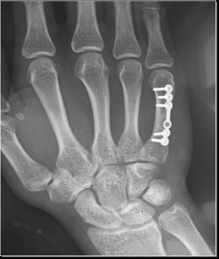 掌骨骨折的治疗