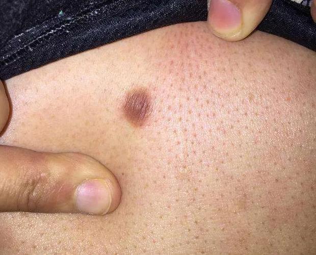 皮肤科医生教你如何分辨身上「小疙瘩」及临床治疗方案汇总