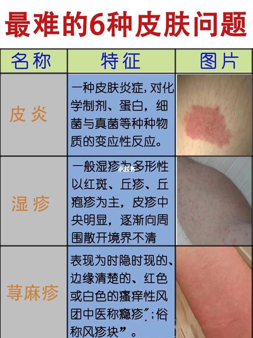 这六种皮肤最常见的皮肤病_皮肤病_医疗健康_医疗健康