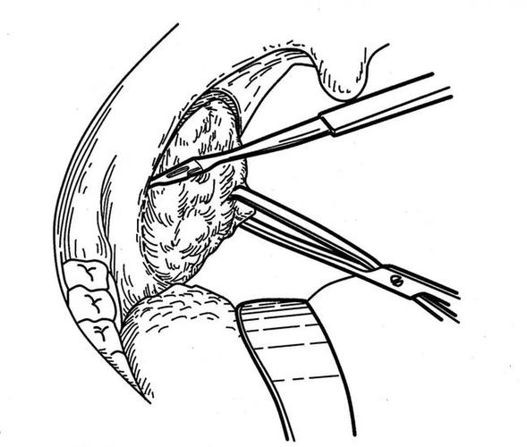 扁桃体什么情况该切超详细腭扁桃体手术全过程