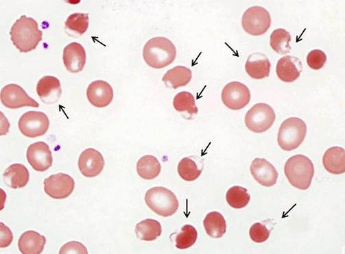 光镜下的海因小体