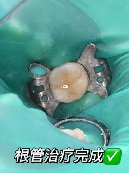 根管治疗超详细过程77干货建议分享_根管治疗_补牙