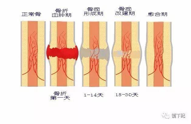 骨折愈合的大致过程